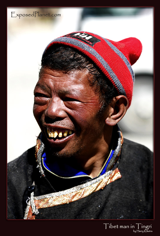 Tibetan man in Tingri in need of dental care